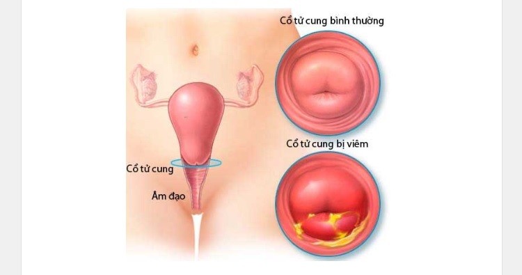 Viêm cổ tử cung
