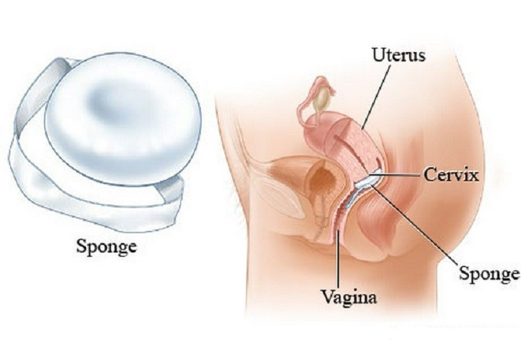 Miếng xốp tránh thai