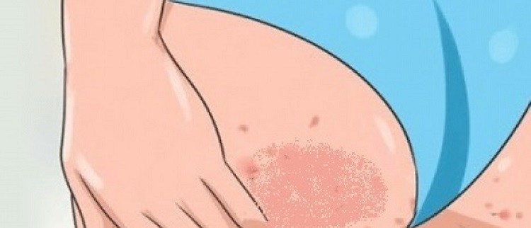 Mẹo trị thâm nách, đầu gối, vùng kín