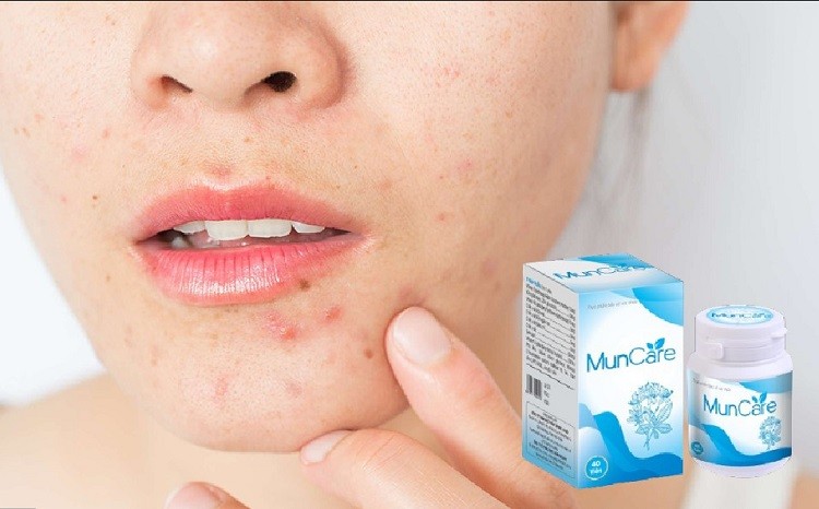 Review viên uống trị mụn MunCare chi tiết thuốc trị mụn muncare, viên uống trị mụn muncare, review viên uống trị mụn muncare, muncare có tốt không