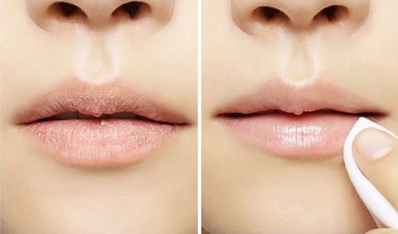 Cách trị môi khô nứt nẻ không còn bong tróc ngay tại nhà cách trị môi khô nứt nẻ tại nhà, cách chữa môi khô nứt nẻ bằng mật ong, cách trị môi khô nứt nẻ vào mùa đông, các cách trị môi khô nứt nẻ