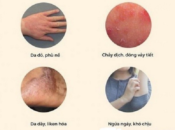 lotion atopiclair,kem dưỡng ẩm atopiclair,dưỡng ẩm atopiclair,thuốc atopiclair, sữa dưỡng ẩm atopiclair